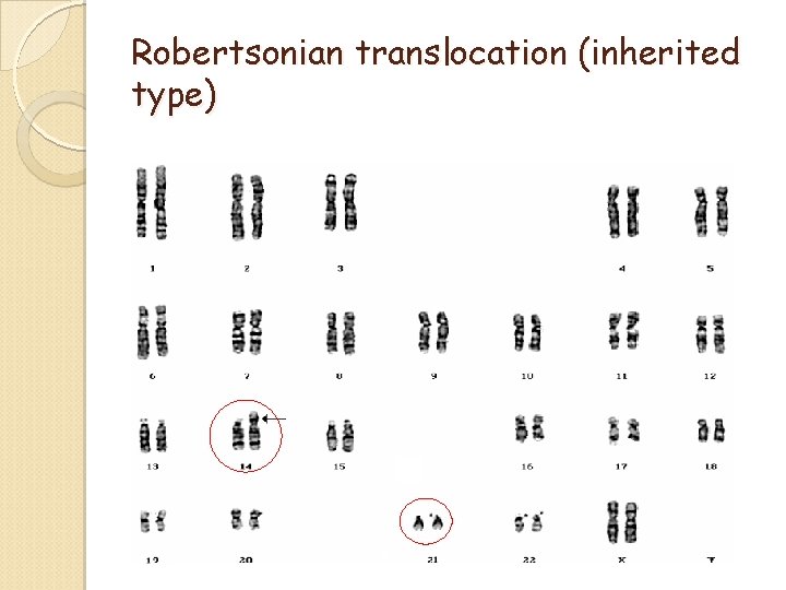Robertsonian translocation (inherited type) Robertsonian translocation (inherited type)