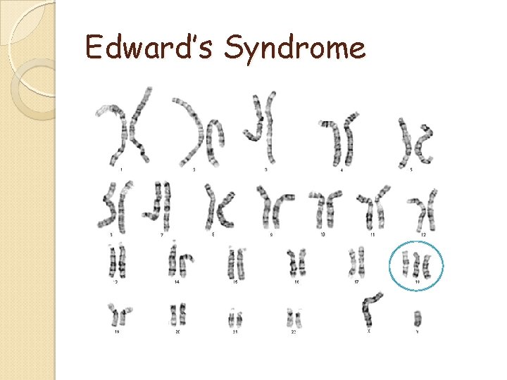 Edward’s Syndrome Edward’s Syndrome