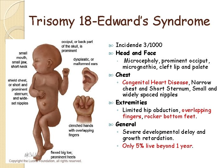 Trisomy 18 -Edward’s Syndrome Incidende 3/1000 Head and Face ◦ Microcephaly, prominent occiput, micrognathia, Trisomy 18 -Edward’s Syndrome Incidende 3/1000 Head and Face ◦ Microcephaly, prominent occiput, micrognathia,