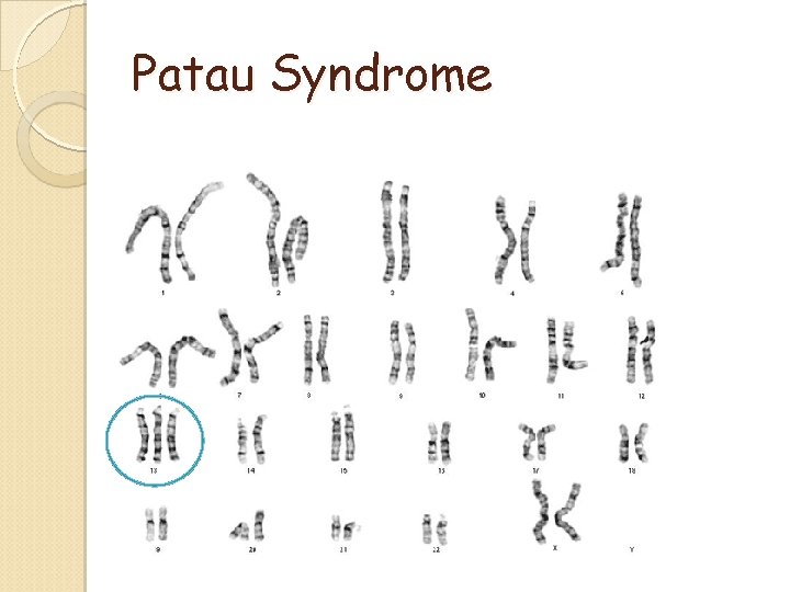Patau Syndrome Patau Syndrome