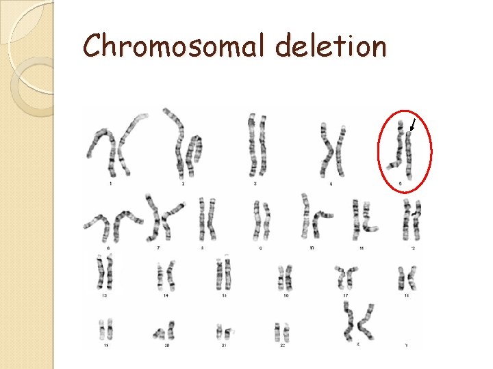 Chromosomal deletion Chromosomal deletion