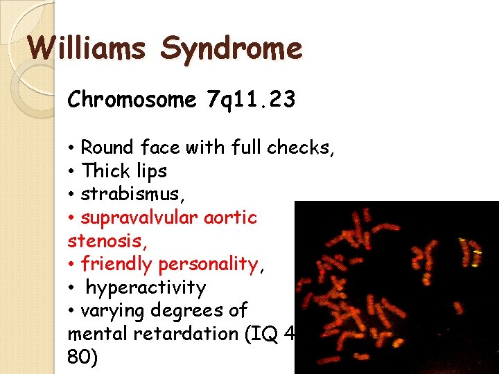 Williams Syndrome Chromosome 7 q 11. 23 • Round face with full checks, • Williams Syndrome Chromosome 7 q 11. 23 • Round face with full checks, •