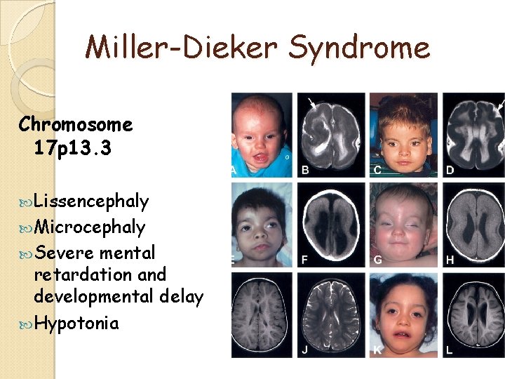 Miller-Dieker Syndrome Chromosome 17 p 13. 3 Lissencephaly Microcephaly Severe mental retardation and developmental Miller-Dieker Syndrome Chromosome 17 p 13. 3 Lissencephaly Microcephaly Severe mental retardation and developmental