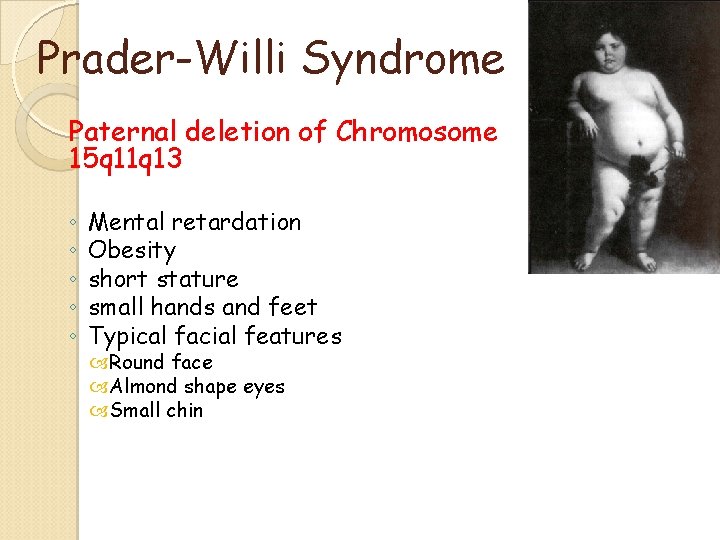 Prader-Willi Syndrome Paternal deletion of Chromosome 15 q 11 q 13 ◦ ◦ ◦ Prader-Willi Syndrome Paternal deletion of Chromosome 15 q 11 q 13 ◦ ◦ ◦