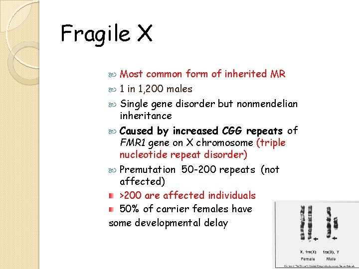 Fragile X Most common form of inherited MR 1 in 1, 200 males Single Fragile X Most common form of inherited MR 1 in 1, 200 males Single
