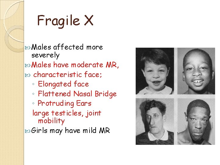 Fragile X Males affected more severely Males have moderate MR, characteristic face; ◦ Elongated Fragile X Males affected more severely Males have moderate MR, characteristic face; ◦ Elongated