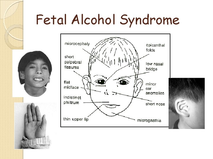 Fetal Alcohol Syndrome Fetal Alcohol Syndrome