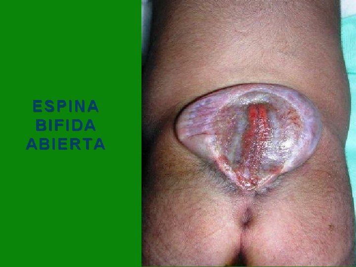 ESPINA BIFIDA ABIERTA 