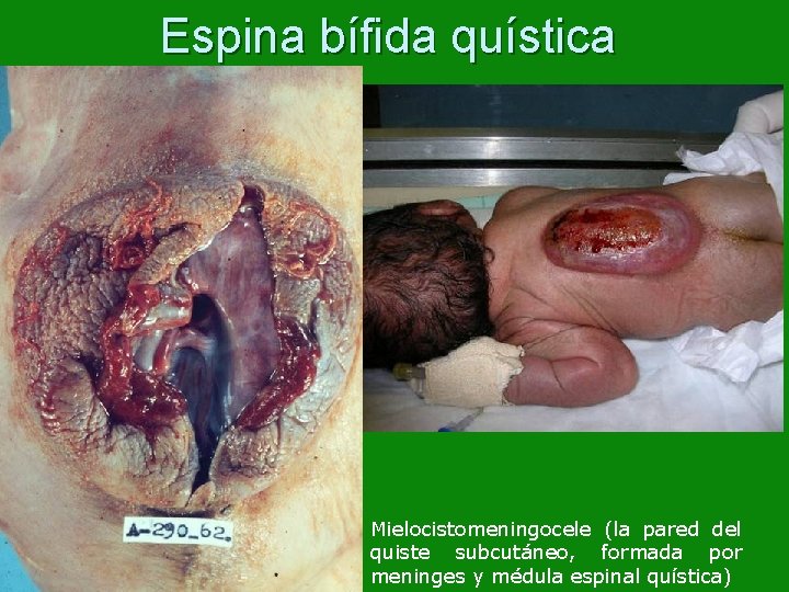 Espina bífida quística Mielocistomeningocele (la pared del quiste subcutáneo, formada por meninges y médula