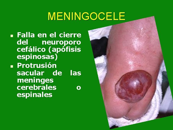 MENINGOCELE n n Falla en el cierre del neuroporo cefálico (apófisis espinosas) Protrusión sacular