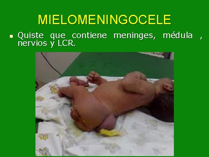 MIELOMENINGOCELE n Quiste que contiene meninges, médula , nervios y LCR. 