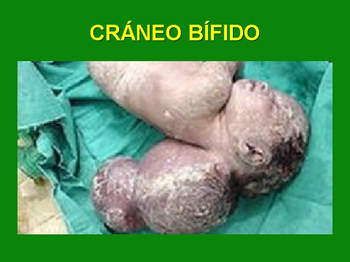 CRÁNEO BÍFIDO 