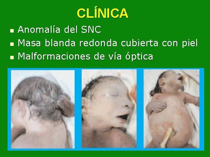 CLÍNICA n n n Anomalía del SNC Masa blanda redonda cubierta con piel Malformaciones