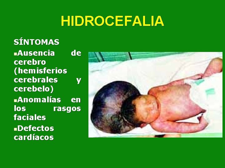 HIDROCEFALIA SÍNTOMAS n. Ausencia de cerebro (hemisferios cerebrales y cerebelo) n. Anomalías en los