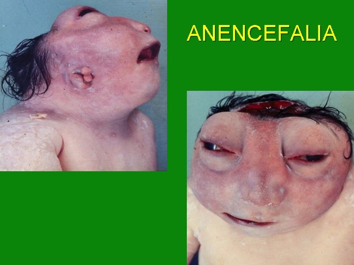 ANENCEFALIA 