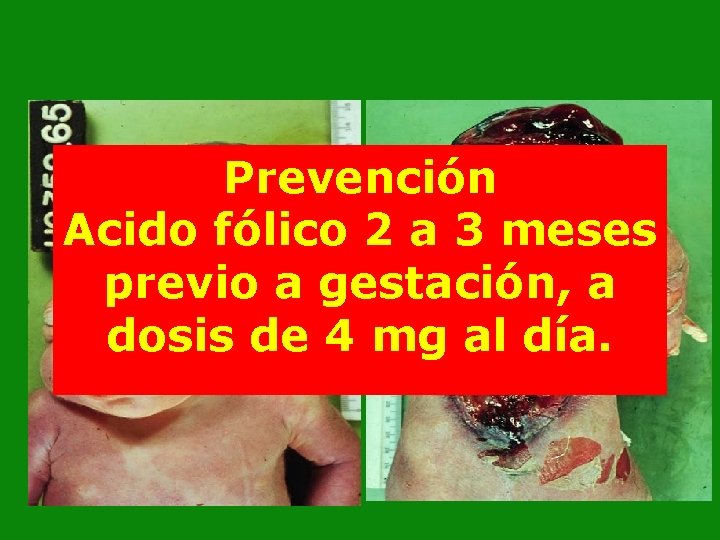 Prevención Acido fólico 2 a 3 meses previo a gestación, a dosis de 4