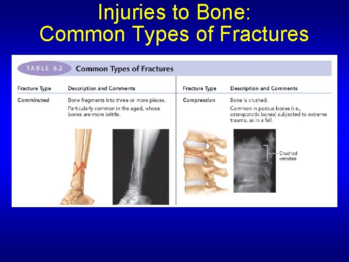 Injuries to Bone: Common Types of Fractures 