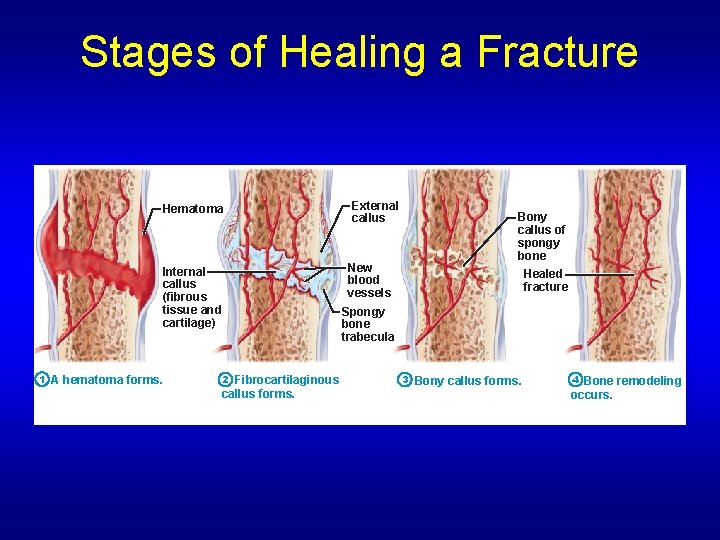 Stages of Healing a Fracture Hematoma A hematoma forms. Bony callus of spongy bone