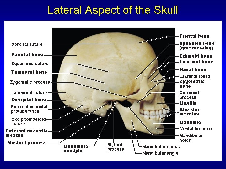 Lateral Aspect of the Skull Frontal bone Coronal suture Sphenoid bone (greater wing) Parietal