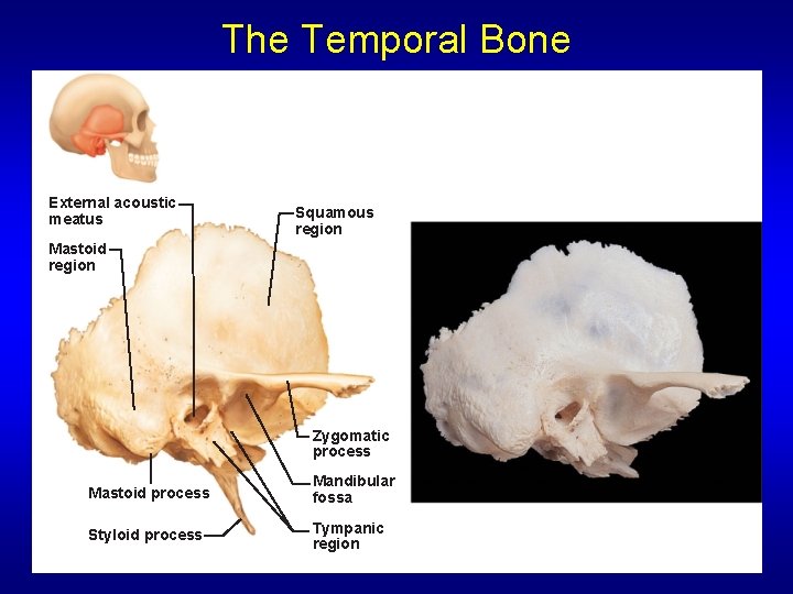 The Temporal Bone External acoustic meatus Squamous region Mastoid region Zygomatic process Mastoid process