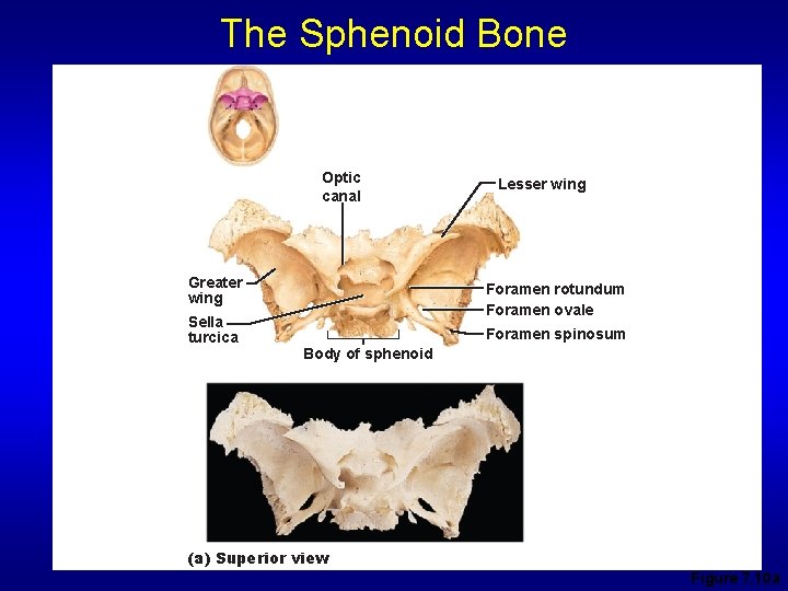 The Sphenoid Bone Optic canal Greater wing Sella turcica Lesser wing Foramen rotundum Foramen