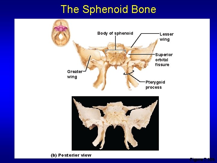 The Sphenoid Bone Body of sphenoid Lesser wing Superior orbital fissure Greater wing Pterygoid