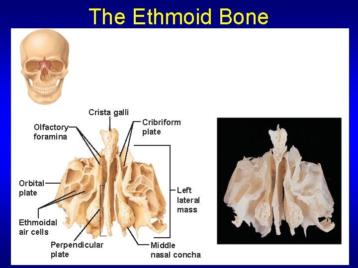 The Ethmoid Bone Crista galli Olfactory foramina Orbital plate Cribriform plate Left lateral mass