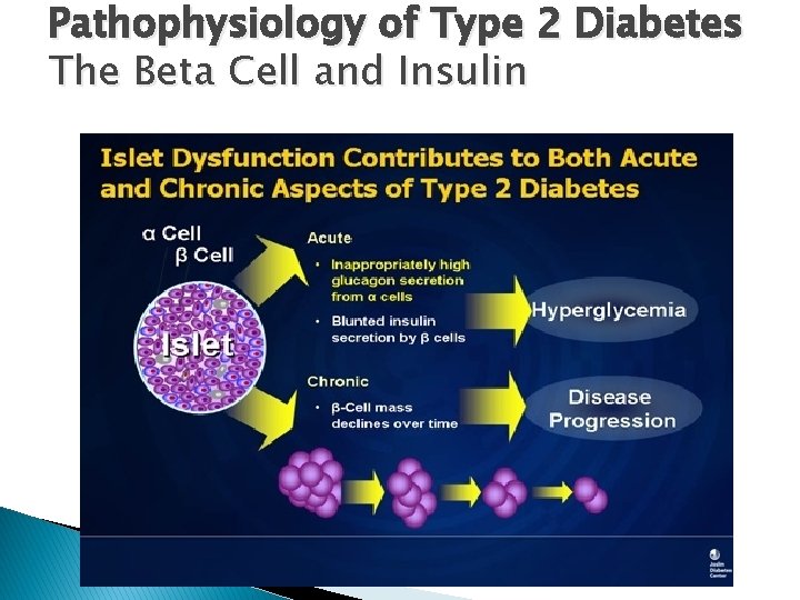 Pathophysiology of Type 2 Diabetes The Beta Cell and Insulin 