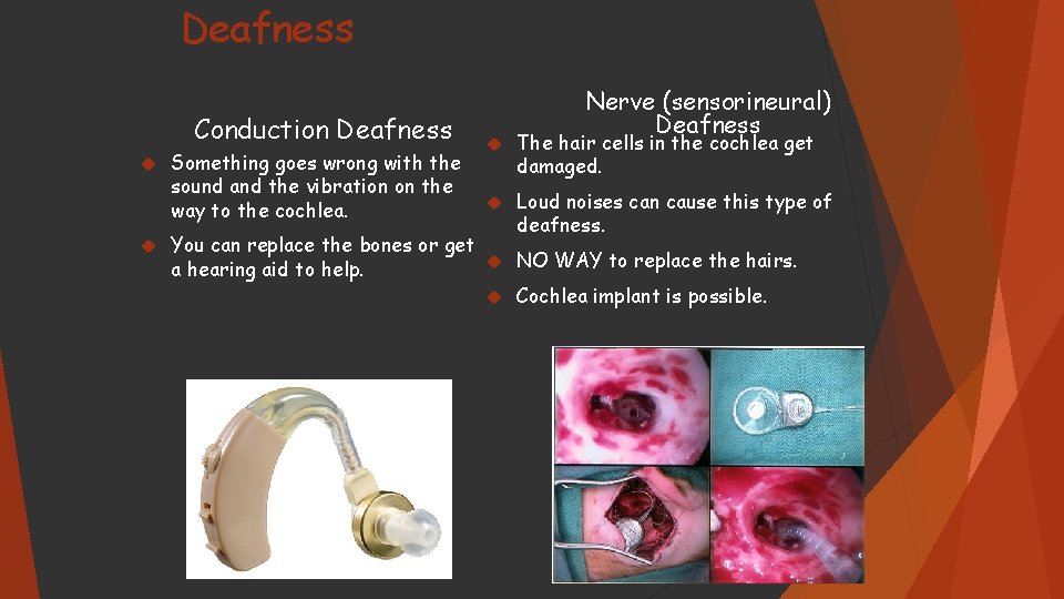 Deafness Conduction Deafness Something goes wrong with the sound and the vibration on the