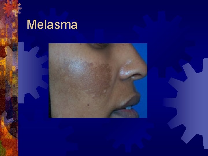 Melasma 