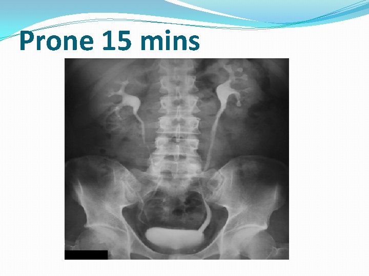 Prone 15 mins Prone 15 mins