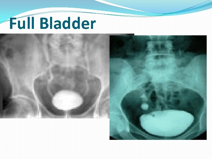 Full Bladder Full Bladder