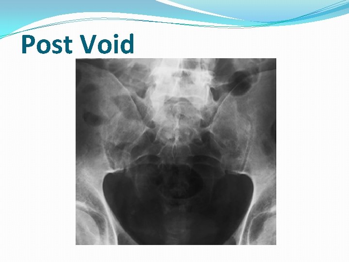 Post Void Post Void