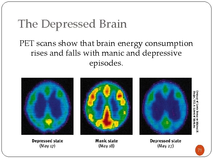 The Depressed Brain PET scans show that brain energy consumption rises and falls with