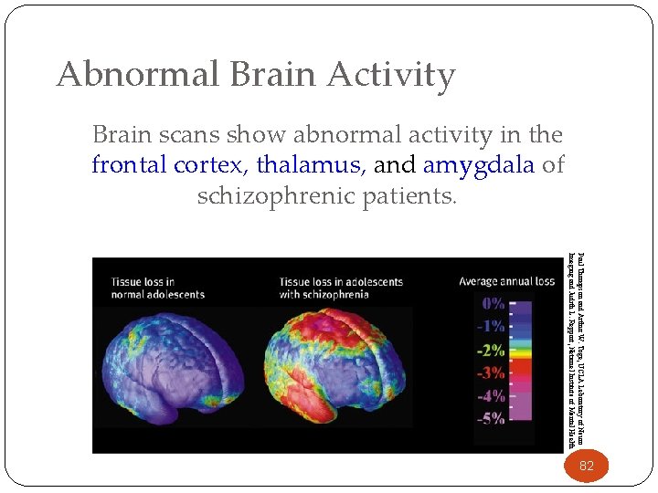 Abnormal Brain Activity Brain scans show abnormal activity in the frontal cortex, thalamus, and