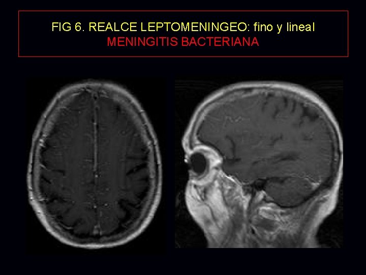FIG 6. REALCE LEPTOMENINGEO: fino y lineal MENINGITIS BACTERIANA FIG 6. REALCE LEPTOMENINGEO: fino y lineal MENINGITIS BACTERIANA