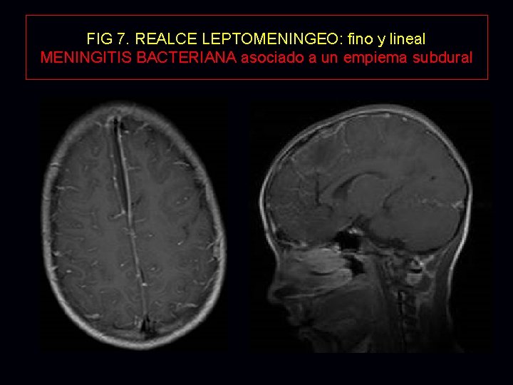 FIG 7. REALCE LEPTOMENINGEO: fino y lineal MENINGITIS BACTERIANA asociado a un empiema subdural FIG 7. REALCE LEPTOMENINGEO: fino y lineal MENINGITIS BACTERIANA asociado a un empiema subdural
