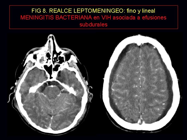 FIG 8. REALCE LEPTOMENINGEO: fino y lineal MENINGITIS BACTERIANA en VIH asociada a efusiones FIG 8. REALCE LEPTOMENINGEO: fino y lineal MENINGITIS BACTERIANA en VIH asociada a efusiones