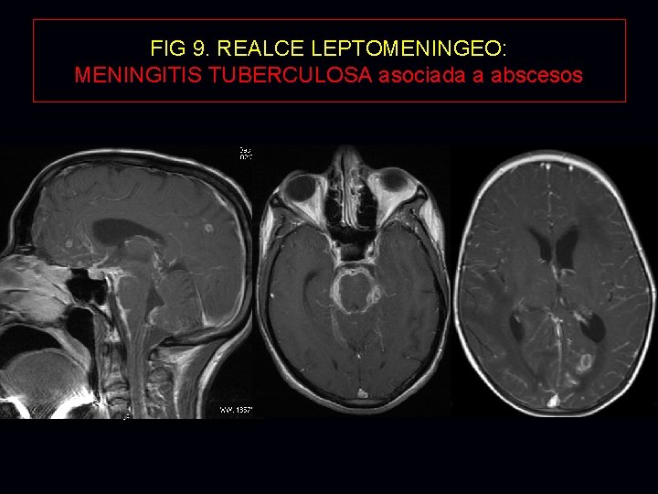 FIG 9. REALCE LEPTOMENINGEO: MENINGITIS TUBERCULOSA asociada a abscesos FIG 9. REALCE LEPTOMENINGEO: MENINGITIS TUBERCULOSA asociada a abscesos