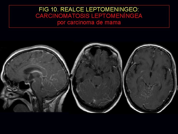 FIG 10. REALCE LEPTOMENINGEO: CARCINOMATOSIS LEPTOMENÍNGEA por carcinoma de mama FIG 10. REALCE LEPTOMENINGEO: CARCINOMATOSIS LEPTOMENÍNGEA por carcinoma de mama