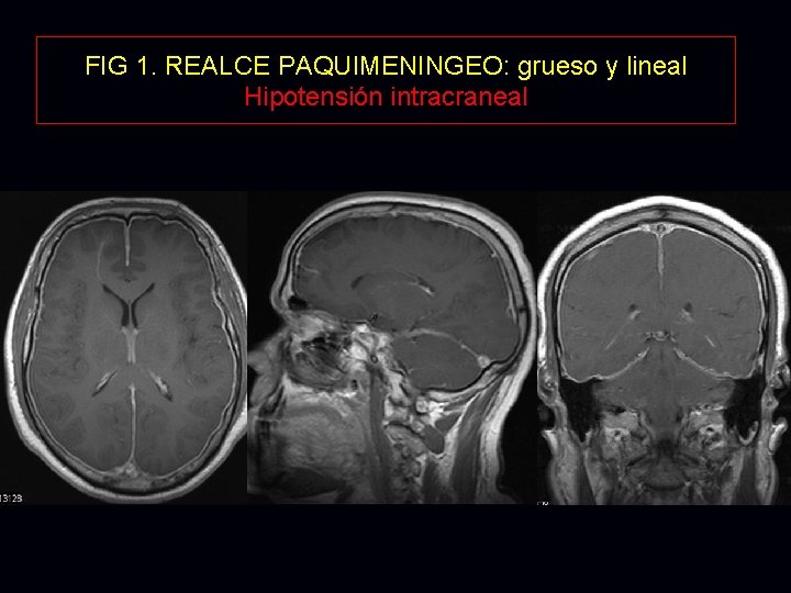 FIG 1. REALCE PAQUIMENINGEO: grueso y lineal Hipotensión intracraneal FIG 1. REALCE PAQUIMENINGEO: grueso y lineal Hipotensión intracraneal