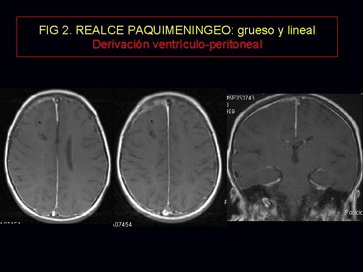 FIG 2. REALCE PAQUIMENINGEO: grueso y lineal Derivación ventrículo-peritoneal FIG 2. REALCE PAQUIMENINGEO: grueso y lineal Derivación ventrículo-peritoneal