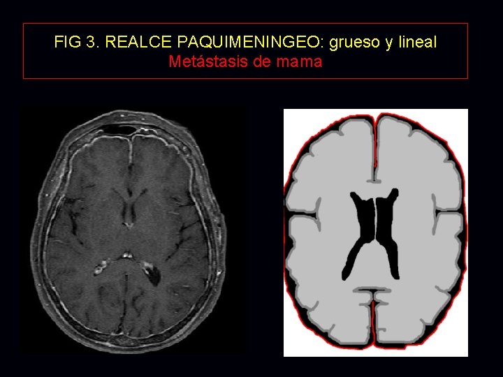 FIG 3. REALCE PAQUIMENINGEO: grueso y lineal Metástasis de mama FIG 3. REALCE PAQUIMENINGEO: grueso y lineal Metástasis de mama