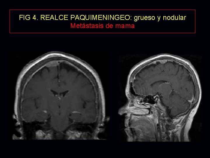 FIG 4. REALCE PAQUIMENINGEO: grueso y nodular Metástasis de mama FIG 4. REALCE PAQUIMENINGEO: grueso y nodular Metástasis de mama