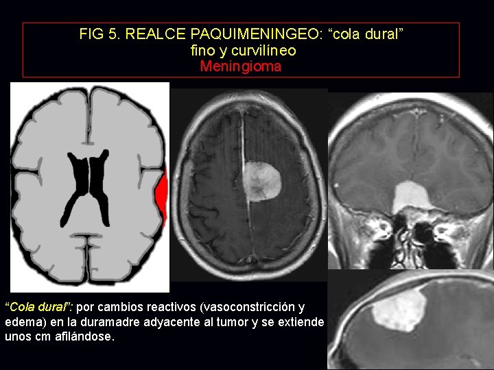 FIG 5. REALCE PAQUIMENINGEO: “cola dural” fino y curvilíneo Meningioma “Cola dural”: por cambios FIG 5. REALCE PAQUIMENINGEO: “cola dural” fino y curvilíneo Meningioma “Cola dural”: por cambios