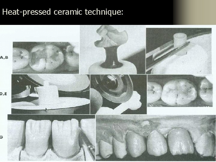 Heat-pressed ceramic technique: 