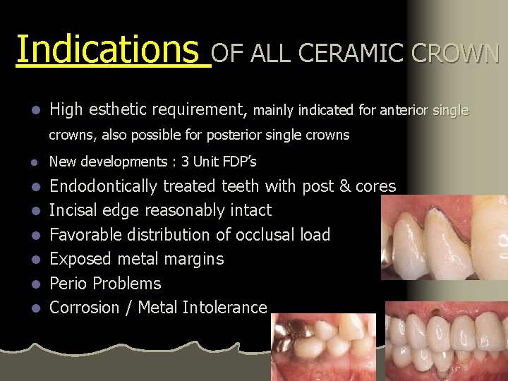 Indications OF ALL CERAMIC CROWN l High esthetic requirement, mainly indicated for anterior single