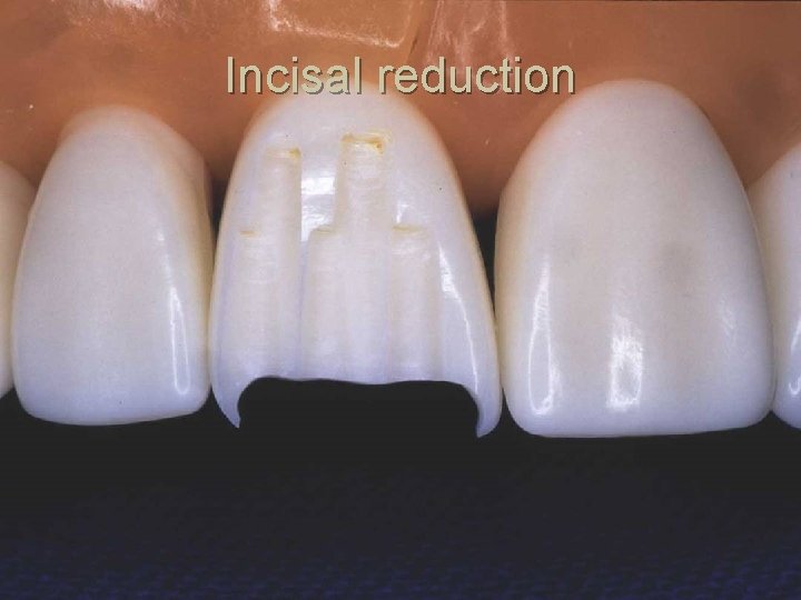 Incisal reduction 