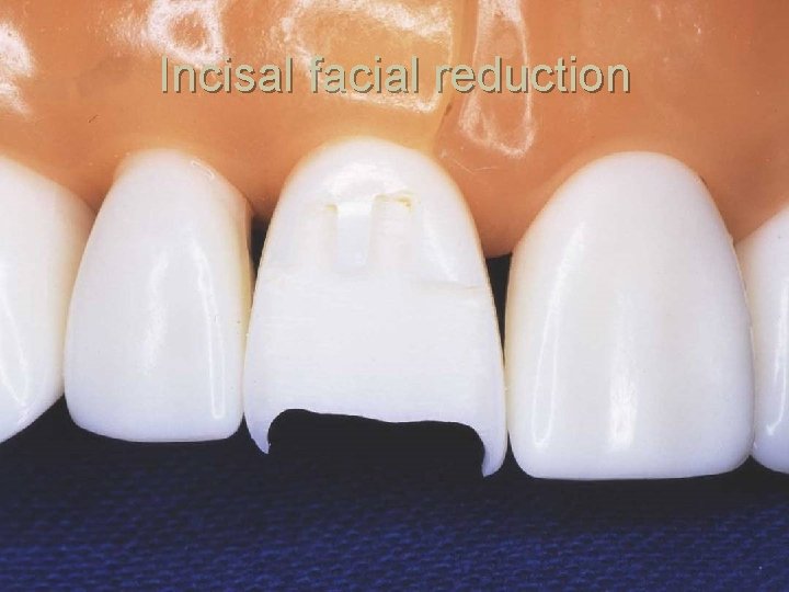 Incisal facial reduction 