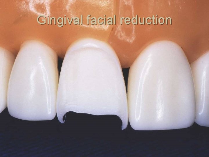 Gingival facial reduction 